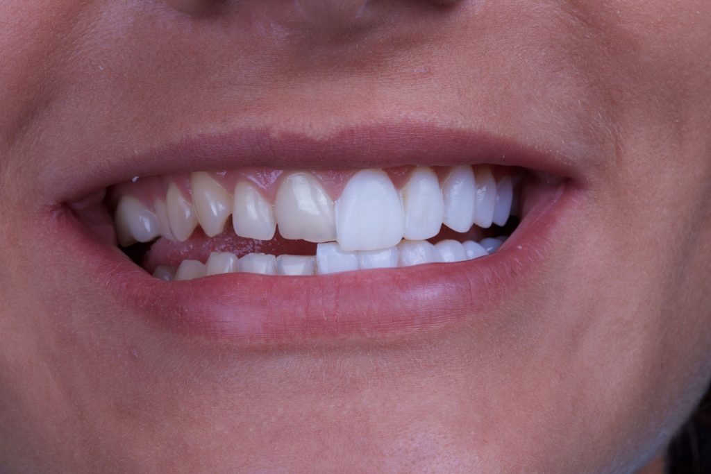 Dental Veneers Vista
